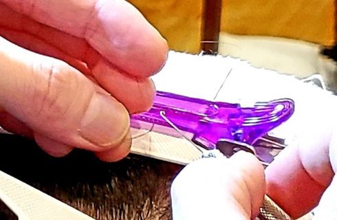 実際の施術